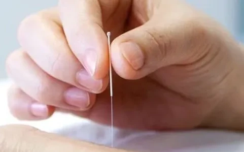 Acupuncture