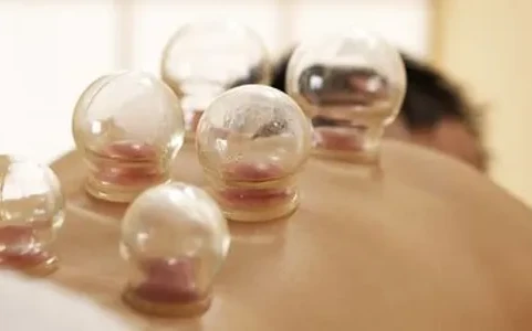 Cupping Therapy