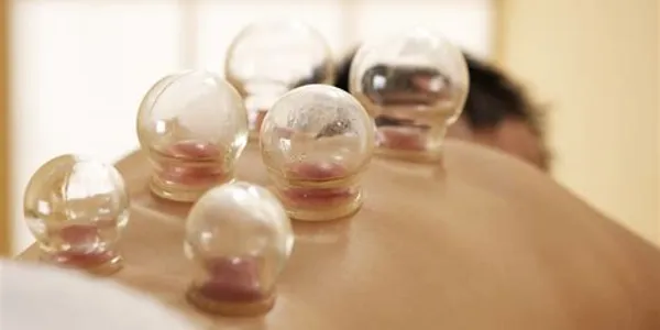 Cupping Therapy
