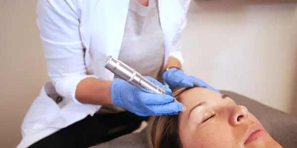 microneedling